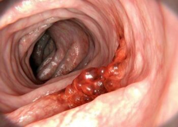 Sintomas que são comuns em quem tem câncer de intestino