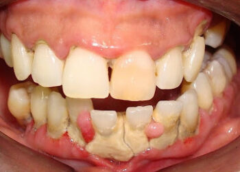 Solução caseira que promete remover o tártaro dos dentes em uma só passada